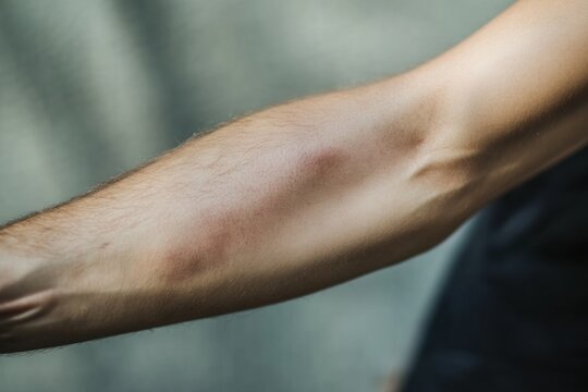 visible bruise on arm