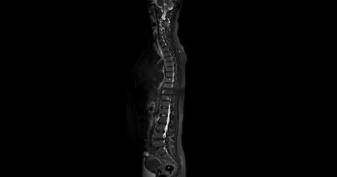 MRI Screening whole spine  sagittal T2  FS showing  spine compress spinal cord ( Myelopathy )