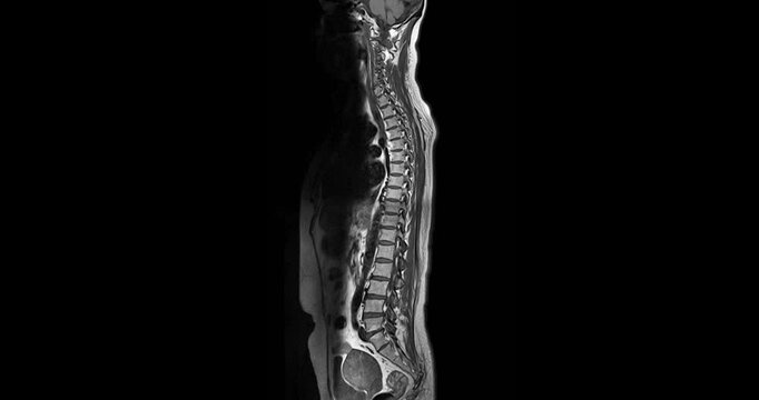MRI Screening whole spine  sagittal T2  FS showing  spine compress spinal cord ( Myelopathy )