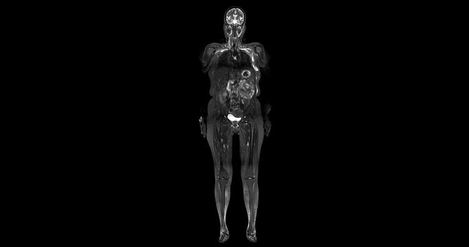 MRI whole body scans are beneficial for early cancer detection, monitoring chronic conditions, and overall health assessments.