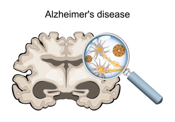 Alzheimers disease. microscopic view of neurons showing neurofibrillary tangles and amyloid plaques