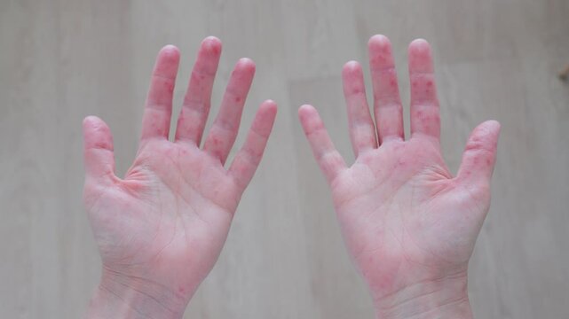 Understanding hand rashes from chickenpox to allergic contact dermatitis