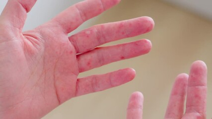 Understanding skin rashes from chickenpox to eczema in a detailed examination