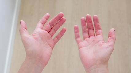Exploring various skin conditions on hands with details on rash and treatment