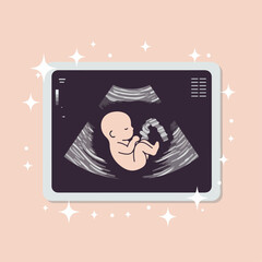 Ultrasound image showing fetus, baby in womb, pregnancy scan. Detailed medical illustration of a developing baby inside mother's uterus.  High-quality image ideal for educational materials, brochures,