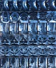 Vertical Mri scan of cervical spine hernia. Medical x-ray examining.