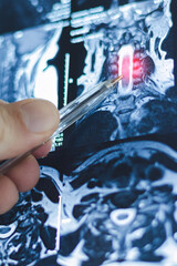 Vertical X-ray of lumbar and thoracic hernias on human spine. Mri of diseases.
