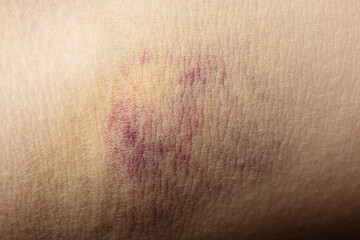 Red bruise on human skin