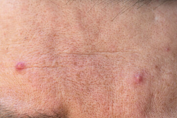 Skin problems. European male forehead with acne and pimples. Macro close up shot