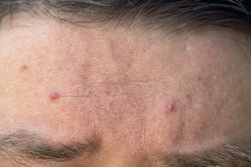 Skin problems. European male forehead with acne and pimples. Macro close up shot