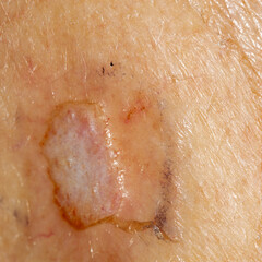 Close up of a skin biopsy site of a concerning lesion