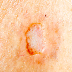 Close up of a skin biopsy site of a concerning lesion