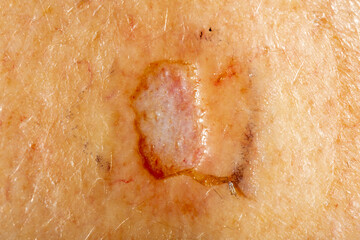 Close up of a skin biopsy site of a concerning lesion