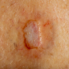 Close up of a skin biopsy site of a concerning lesion