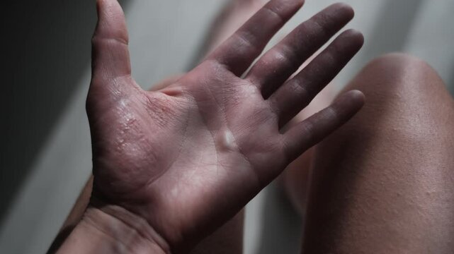 Close-up: a woman is showing her palm with eczema - red, dry, wet flaky skin on her hands. Best used for scientific, clinical, or documentary use 