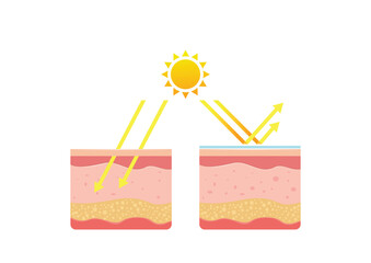 Uv skin protection. Damaged human skin peels before and after sun protection body adipose layers epidermis recent vector infographic template. Uv sunburn, ultraviolet to body damage illustration