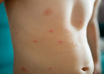 Varicella virus or Chickenpox bubble rash on child, baby or adult