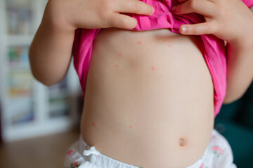 Baby with chicken pox rash. Varicella virus or Chickenpox bubble rash on child. Dermatology...