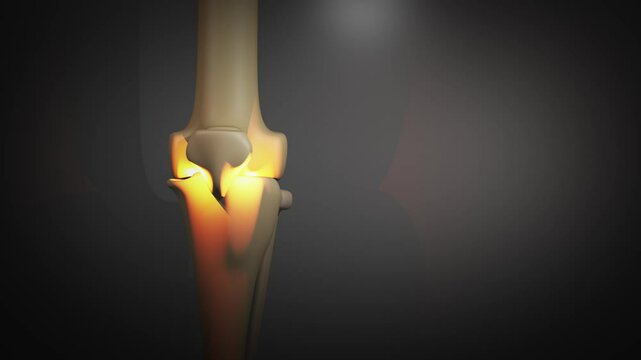 3D Animation of Inflamed Bone-On-Bone Knee Joint