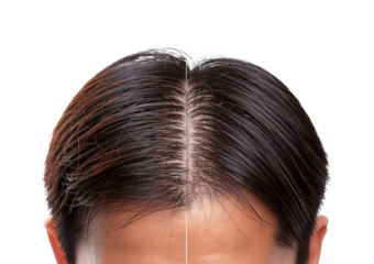 Man showing hair loss and restored hair side by side isolated on transparent or white background
