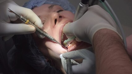 Group of dentists drills and removes remaining parts of tooth in female patient cavity. Professionals focused on preparing for implant placement