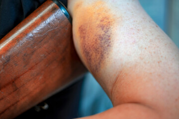 bruise on the arm of a beginner shooter