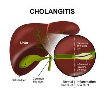 Cholangitis Liver narrowed bile duct illustration