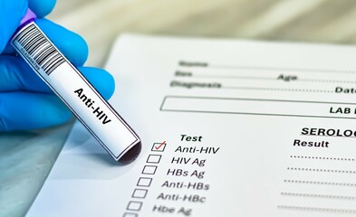 Blood sample tube and paper order request for anti-HIV test analysis.