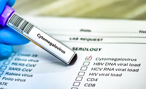 Blood sample tube and paper order request for cytomegalovirus test analysis.