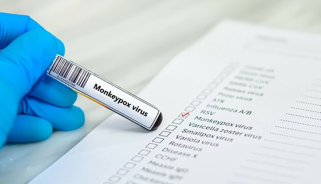 Blood sample tube and paper order request for monkeypox virus test analysis. - Powered by Adobe