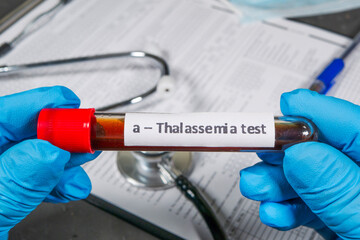 Doctor is holding test tube with blood sample for alpha thalassemia test