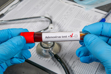 Doctor holding positive adenovirus blood test tube, infection and diagnostic concept