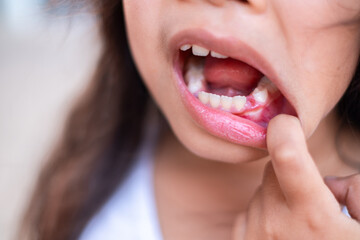 Close up of a child showing a mouth injury with redness on the gum. The child pulls down the lower lip to reveal the affected area. Health and dental care concept.