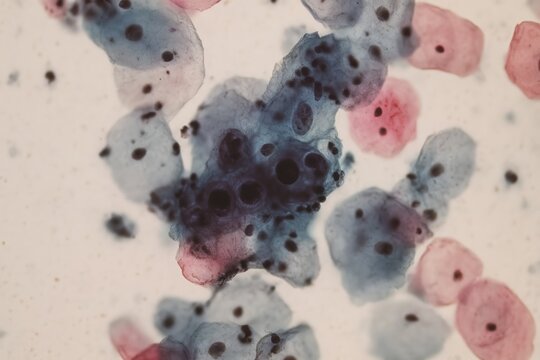 Microscopic close-up of cervical epithelial cells infected with human papillomavirus, showing enlarged dark nuclei and irregular clusters of koilocytes. 