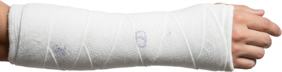 Close-up of a human arm wrapped in a white medical cast, extending from the upper arm to the fingers, suggesting a broken or fractured limb being treated and stabilized. Transparent Background