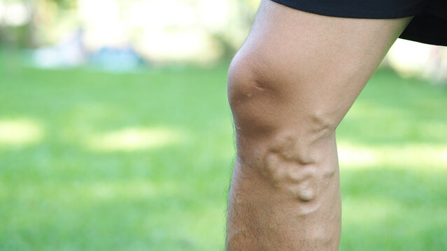 Varicose veins on the legs of men