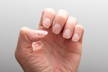 Detailed close-up of a hand showing brittle, dry, and peeling nails, with dehydrated skin on a neutral gray background. Concept of nail health. Allergic reactions to manicure products