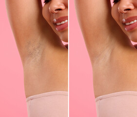 Before and after epilation. Woman showing armpit on pink background, closeup. Collage