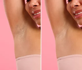 Fotobehang Before and after epilation. Woman showing armpit on pink background, closeup. Collage © New Africa