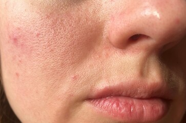 Fototapeta premium Macro image showing acne, skin pores, and lip area of a young woman in daylight. Realistic texture ideal for skincare, dermatology, and beauty-related visual content.