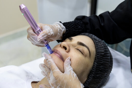 Esthetician performing microneedling on lips to stimulate collagen and revitalize skin