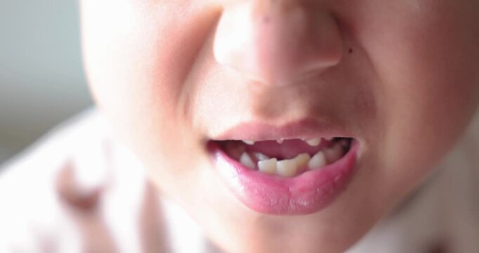 Close up of kid smiling with missing front tooth, child dental care, milk teeth falling out, childhood oral health, happy boy showing tooth gap, first lost tooth, growing up concept. 4K video.