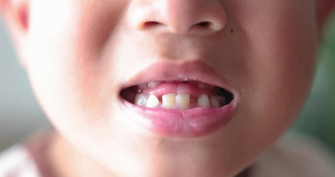 Close up of kid smiling with missing front tooth, child dental care, milk teeth falling out, childhood oral health, happy boy showing tooth gap, first lost tooth, growing up concept. 4K video.