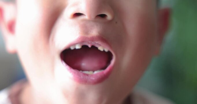 Close up of kid smiling with missing front tooth, child dental care, milk teeth falling out, childhood oral health, happy boy showing tooth gap, first lost tooth, growing up concept. 4K video.
