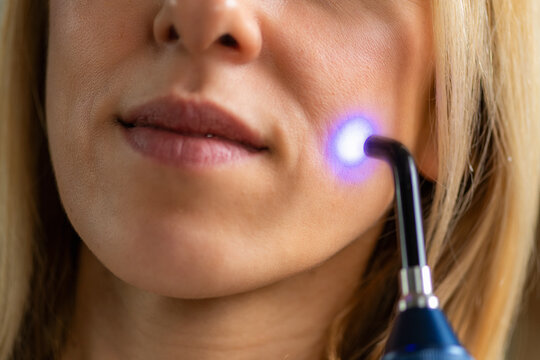 Blue light therapy treats facial acne by eliminating bacteria and reducing inflammation. It supports skin healing and improves complexion with safe, targeted care.