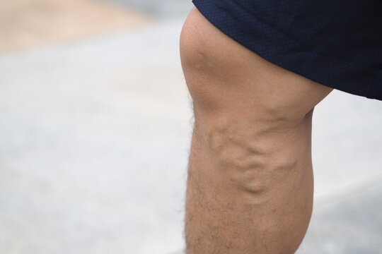 Varicose veins on the legs of men