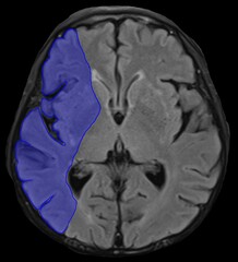 the distribution of right M1 segment