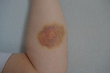 Bruise on human forearm. Close-up of hematoma on pale skin, medical injury concept, trauma...