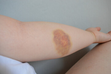Bruise on human forearm. Close-up of hematoma on pale skin, medical injury concept, trauma...
