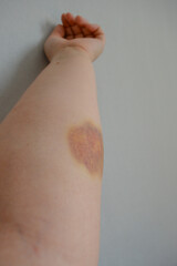 Bruise on human forearm. Close-up of hematoma on pale skin, medical injury concept, trauma...